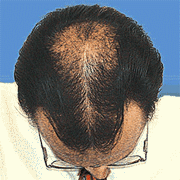 Камуфляж для волос – экономичная альтернатива наращиванию и пересадке