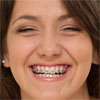 Красивые зубы и прикус: Как выбрать брекет-систему?