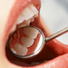 Не пора ли обратиться к стоматологу? О чем говорят полоски на эмали зубов