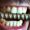 Без скрежета зубовного: Что такое бруксизм и как избавиться от скрипа зубами?