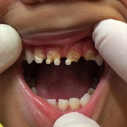 Почему приходится удалять детские молочные зубы?