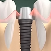 Имплантация сразу после удаления зуба