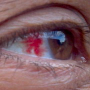 Тромбоз сетчатки глаза. Болезнь, которая опасна для жизни?